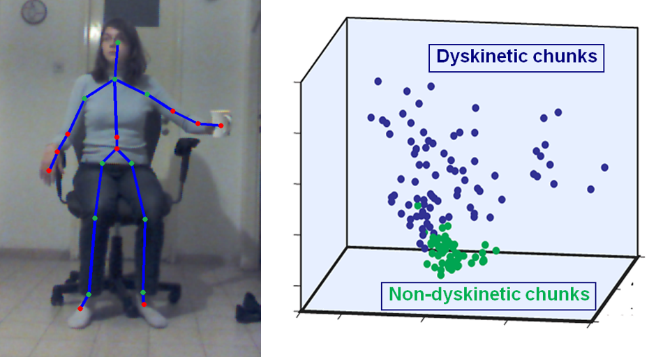 Using Motion Capture and Machine Learning to Qualify Dyskinesia in Parkinson's Disease
